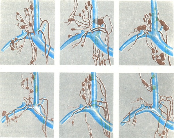 форми поділу шийної частини грудного протоку