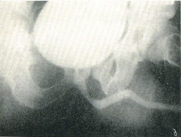 спадна уретрограмма