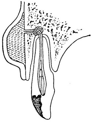 розвиток гострого гнійного періоститу щелепи