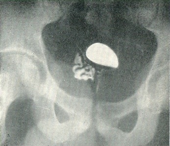 нормальна лівостороння везикулограмма