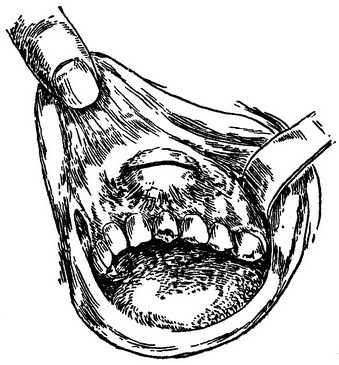 лінія розрізу при розтині абсцесу напередодні порожнини рота