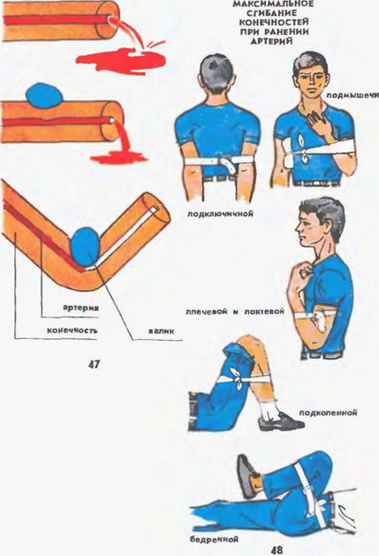 максимальне згинання кінцівок при пораненні артерій