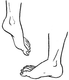 пошкодження сідничного нерва