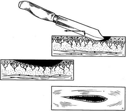 освіта різаної рани