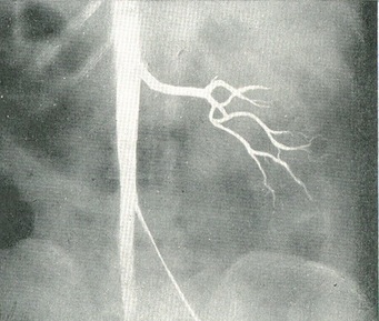 аплазія лівої нирки