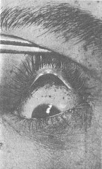 субконъюнктивальные екхімози