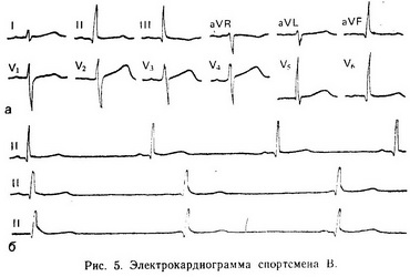 електрокардіограма спортсмена В