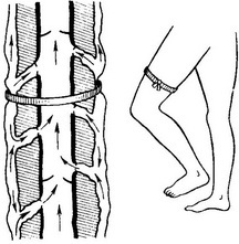 проба Пертеса