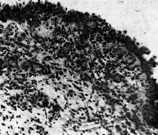 гострий гонорейний та трихомонадний уретрит