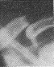 закритий поперечний перелом ключиці зі зміщенням