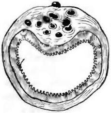 ендометріоз в стінці кишки