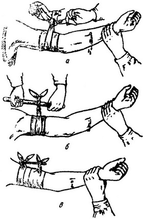 зупинка артеріальної кровотечі закруткою в картинках