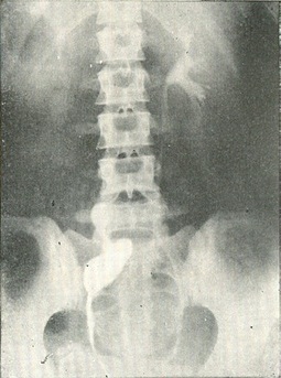 дистопированная нирка зліва