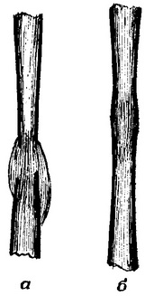 схема рентгенограми утворення кісткової мозолі після перелому кістки гомілки