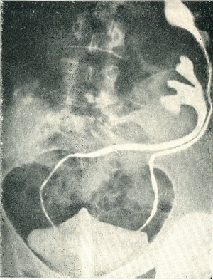 перехресна дістопія лівої нирки