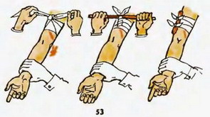 накладення джгута при артеріальній кровотечі