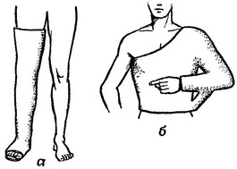 гіпсові пов'язки при переломі