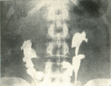 пієлограма підковоподібної нирки