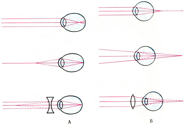 схема ходу світлового пучка очей при короткозорості і далекозорості