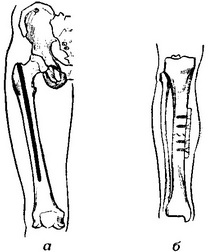 з'єднання відламків кістки