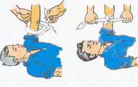 накладання джгута при венозній кровотечі