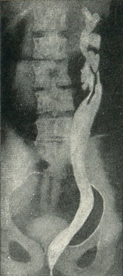 ектопія устя сечоводу