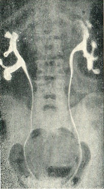 полікістоз нирок