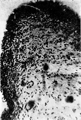 гострий трихомонадний уретрит