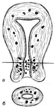 аденоміоз (ендометріоз матки