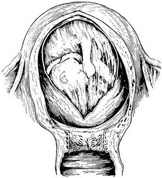 розташування шестимісячного плода в матці