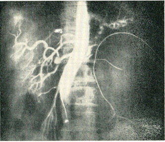 солітарна кіста лівої нирки ангіограма