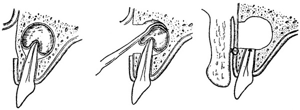 цистектомія