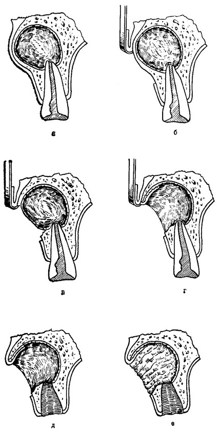 цистотомія зуб видалений