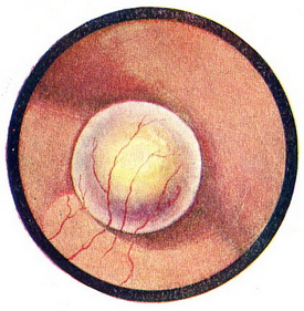 уретероцеле цистоскопія