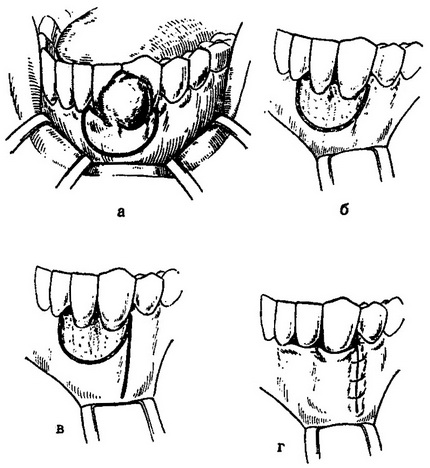 операція видалення эпулиса