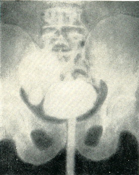 дивертикул сечового міхура цистограмма