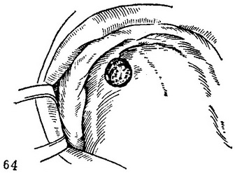 папілома на твердому небі