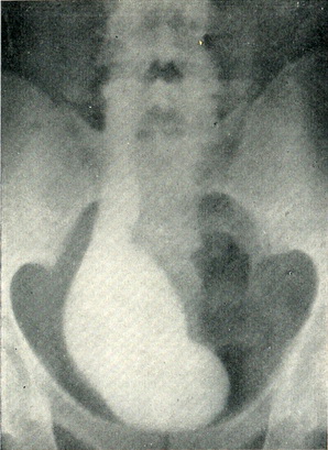 незарощення сечового міхура