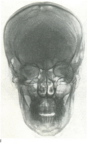 передня оглядова рентгенограма черепа