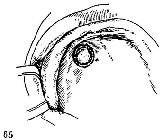 рана після видалення папіломи на твердому небі