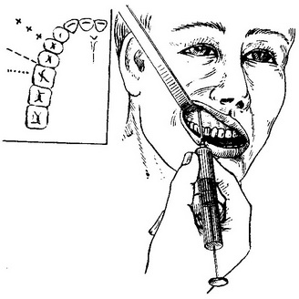 туберальна анестезія