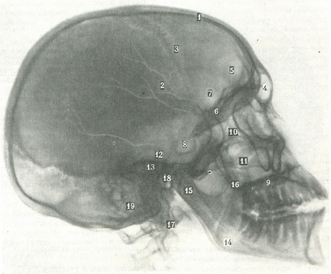бічна оглядова рентгенограма черепа