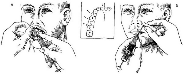 внутрішньоротовою і зовнішьоротової методи анестезії підочного нерва
