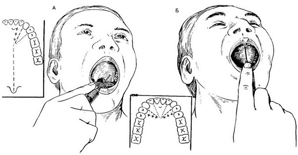 внутрішньоротові методи анестезії нервів твердого неба