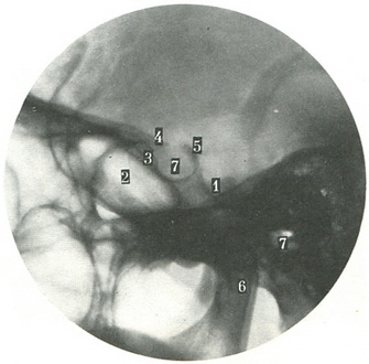 бічна прицільна рентгенограма турецького сідла