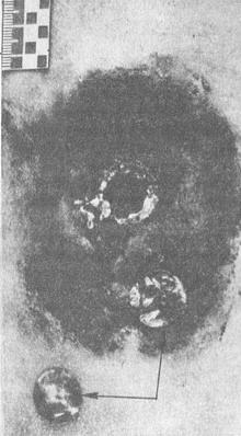 вхідна вогнестрільна рана