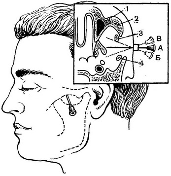 метод анестезії гілок трійчастого нерва схема положення голки