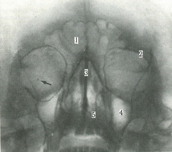 оглядовий знімок очниць