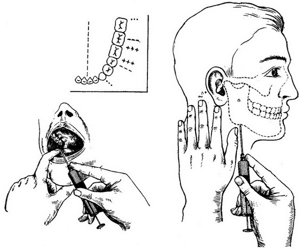 зовнішьоротової і внутрішньоротовою методи знеболювання нижнього альвеолярного нерва
