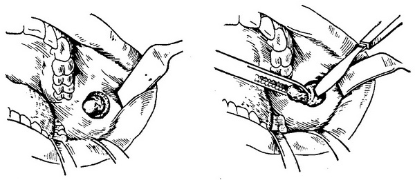 операція видалення фіброми на внутрішній поверхні щоки